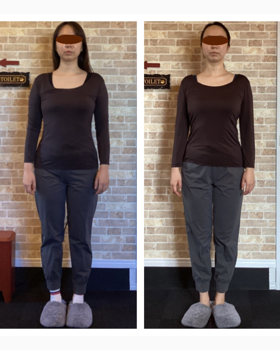 20代女性のプロポーション矯正ビフォーアフター。正面から見たフェイスライン・全身シルエットの変化
