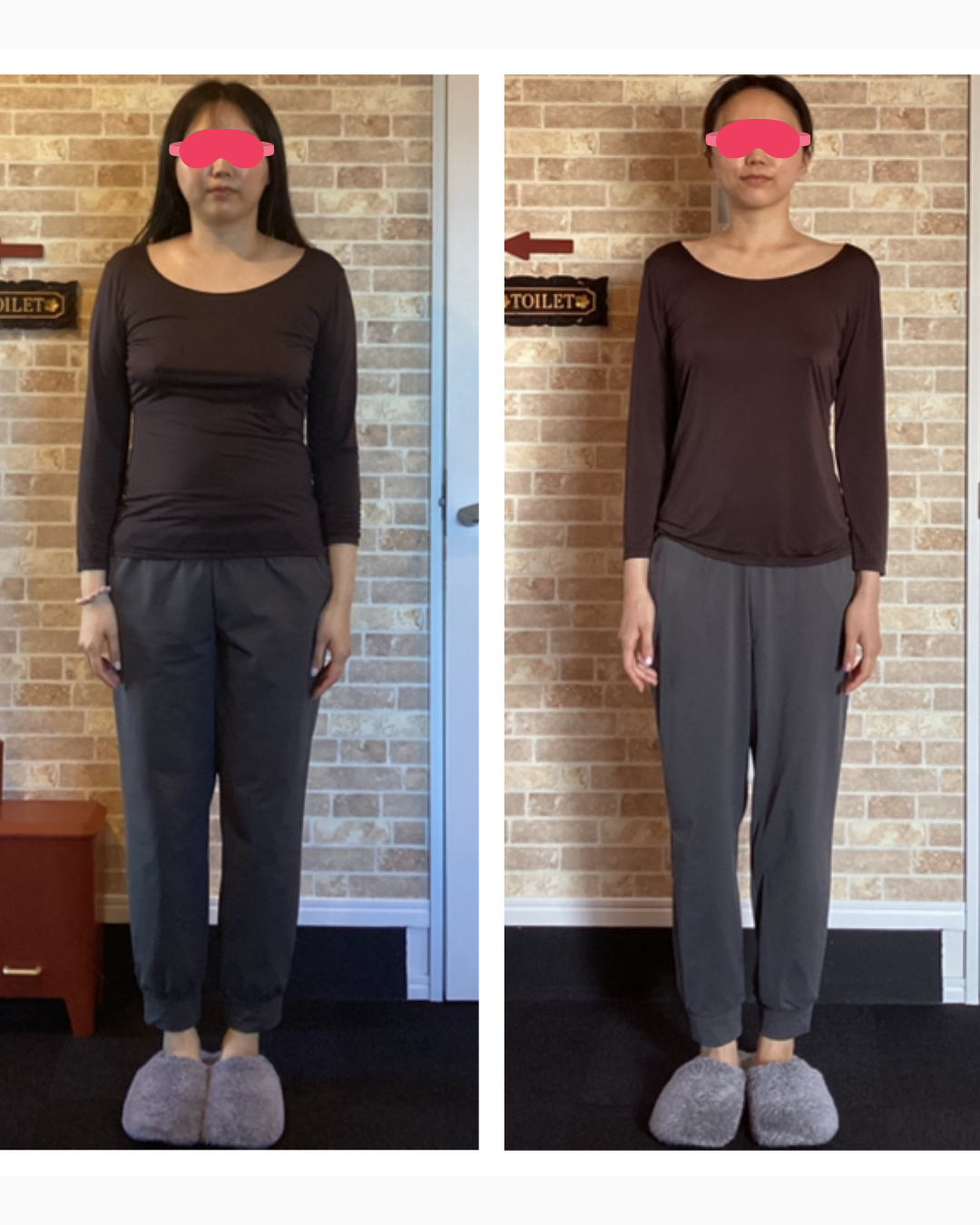 30代前半女性の産後プロポーション矯正ビフォーアフター。正面からの比較で−14.5kgの変化