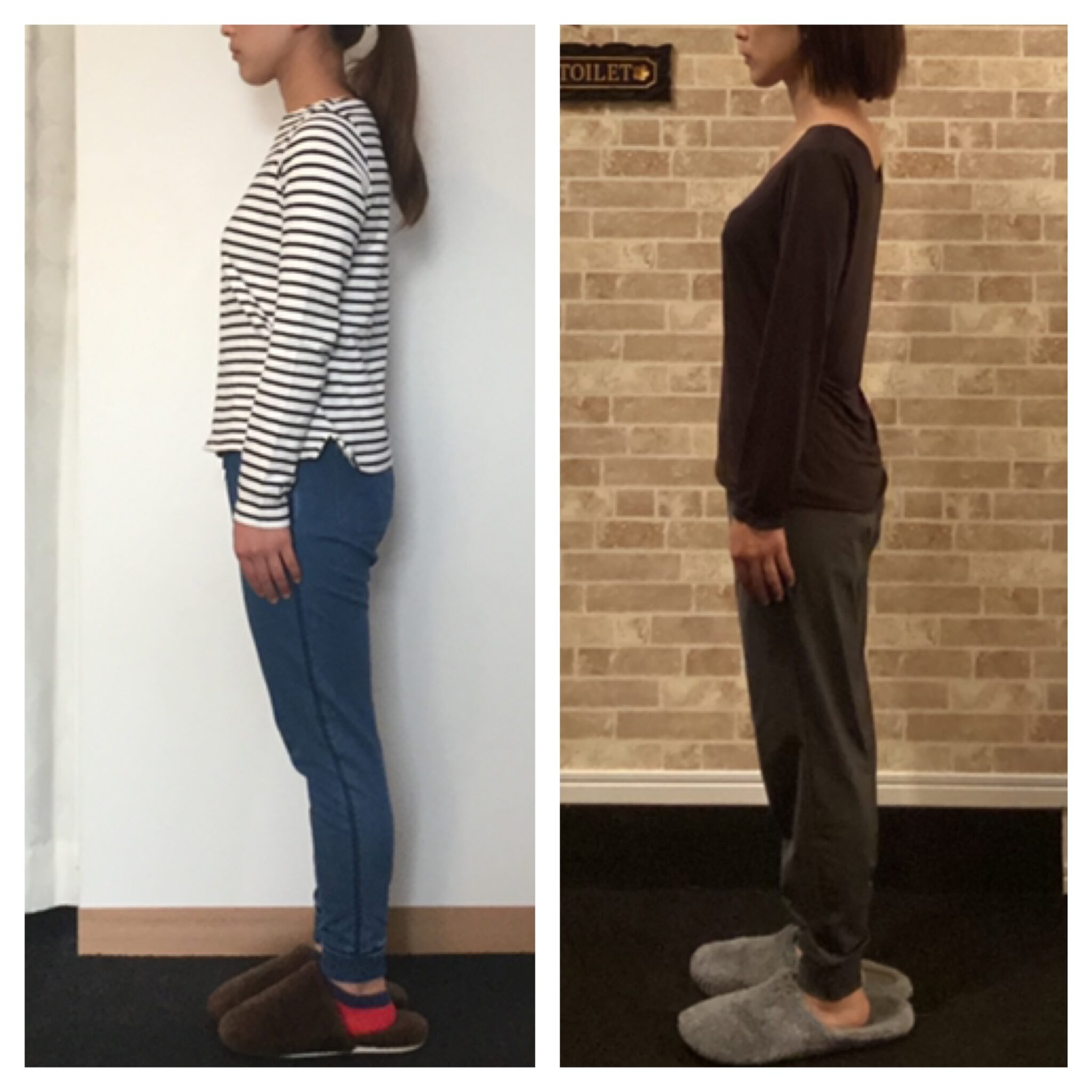 20代女性のプロポーション矯正ビフォーアフター。8年半継続でストレートネック改善・全身バランス向上